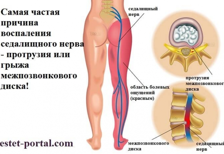 3 упражнения для разблокировки ущемления седалищного нерва