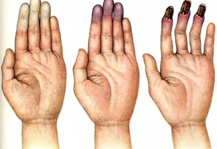 Болезнь холодных пальцев: как распознать синдром Рейно