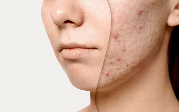 CellRenew Microneedling: авторский протокол лечения постакне