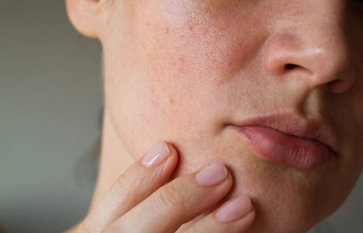 Демодекоз на лице: симптомы, причины и лечение заболевания