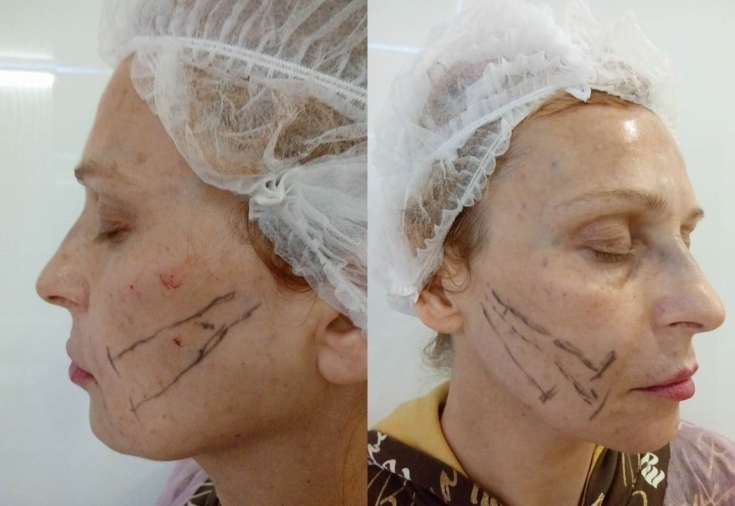 Эффективное омоложение после 50 лет: комбинация anti-age процедур