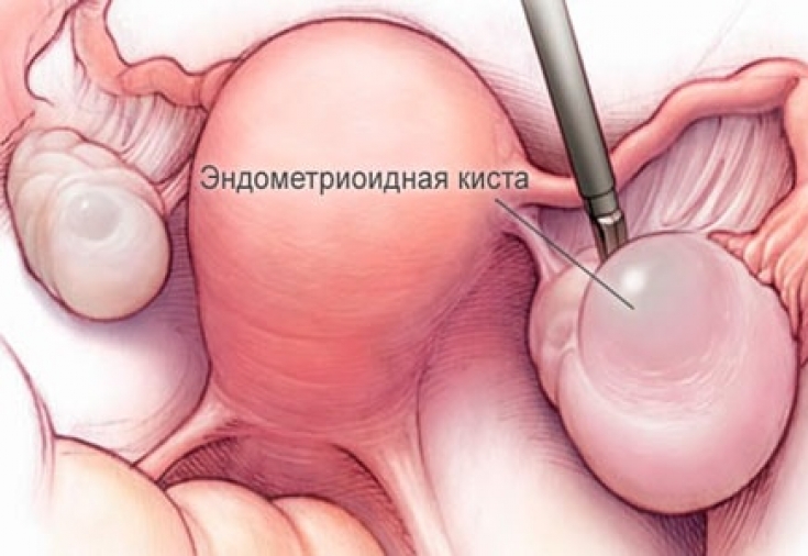 Эндометриоз яичников: какими симптомами могут проявляться «шоколадные кисты»
