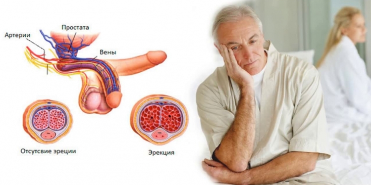 Эректильная дисфункция и артериальная гипертензия: патологическая связь