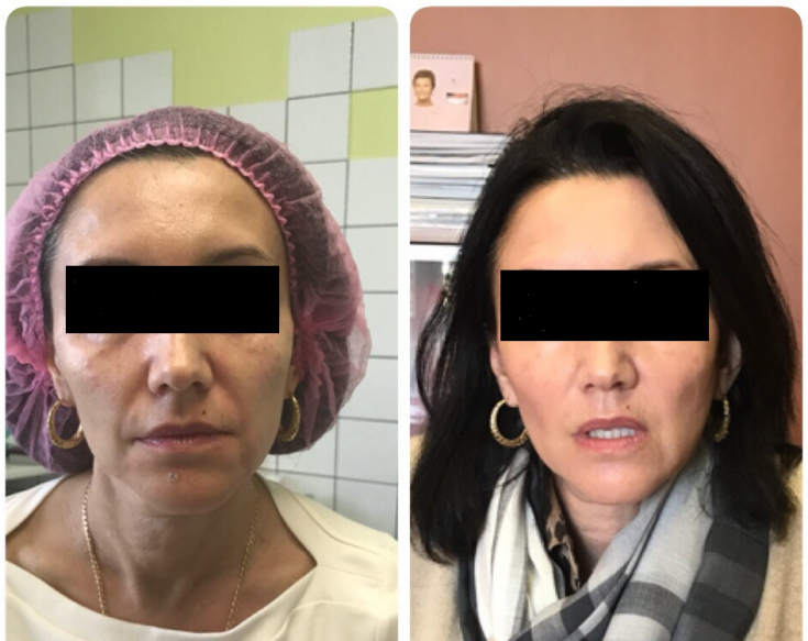 Full face коррекция: экспертный кейс 50+