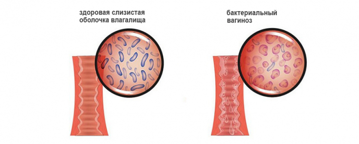 Гайдлайн по лечению бактериального вагиноза