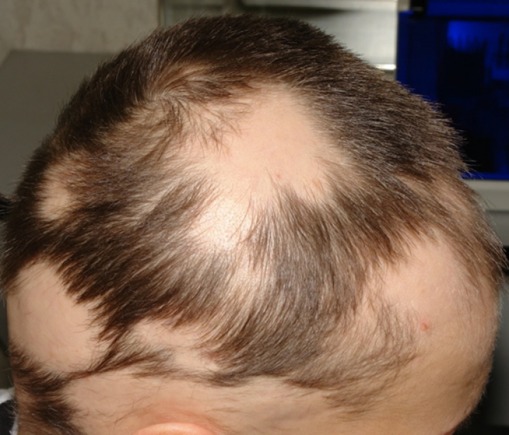 Гнездная алопеция: обыкновенное выпадение волос или тревожный сигнал