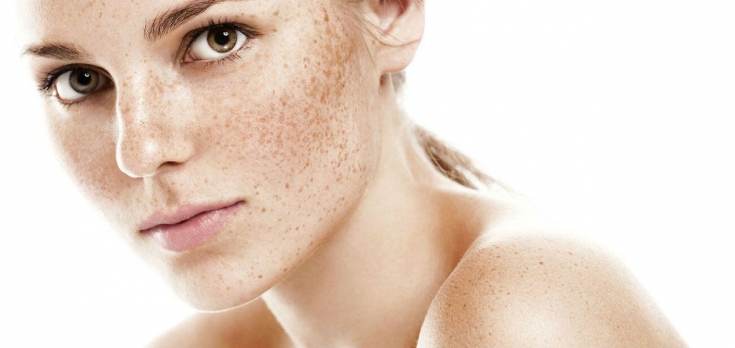 Как избавиться от гиперпигментации и улучшить цвет кожи лица