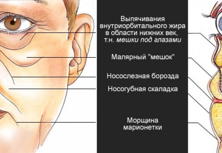 Как избавиться от малярных мешков