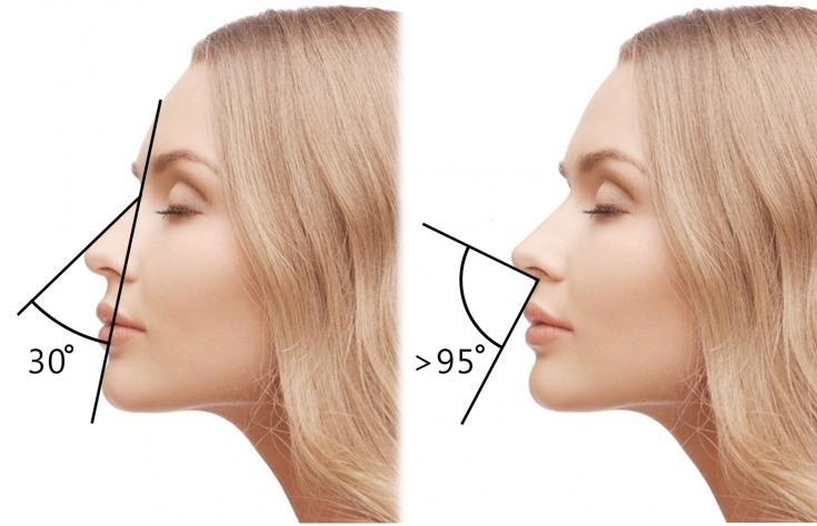Как изменить форму носа без операции: возможности инъекционной коррекции