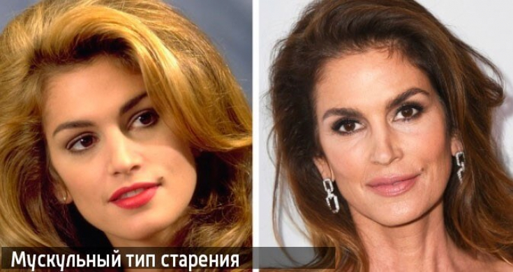 Как правильно подобрать процедуры при коррекции мускульного морфотипа старения