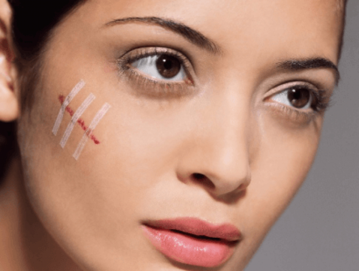 Келоидные рубцы: причины возникновения и методы лечения