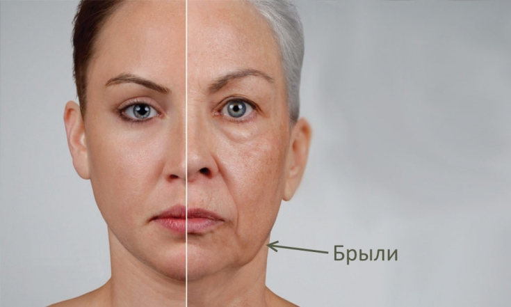 Причины появления брылей и коррекция обвисших щек