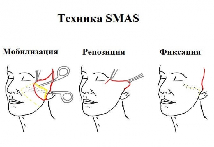 Круговая подтяжка лица и SMAS-лифтинг: особенности методик