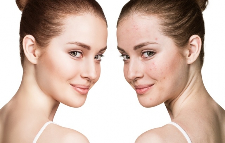 Лечение акне: секреты эффективного ухода за кожей