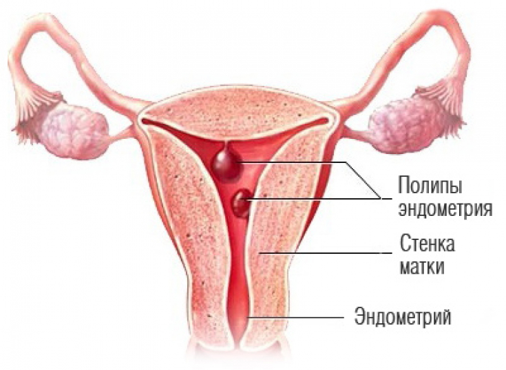 Лечение полипа эндометрия: самые эффективные виды терапии