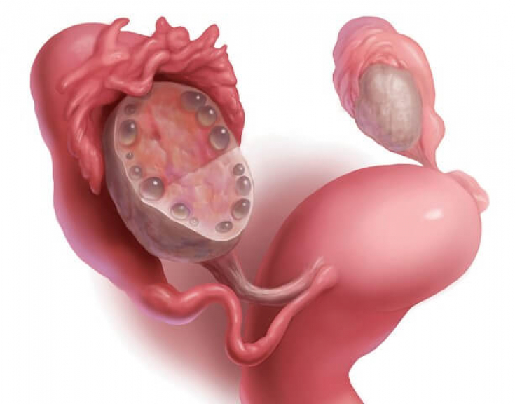 Лечение СПКЯ: Как забеременеть при синдроме поликистозных яичников