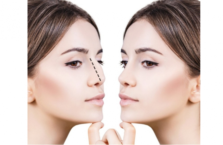 Новые подходы к ринопластике