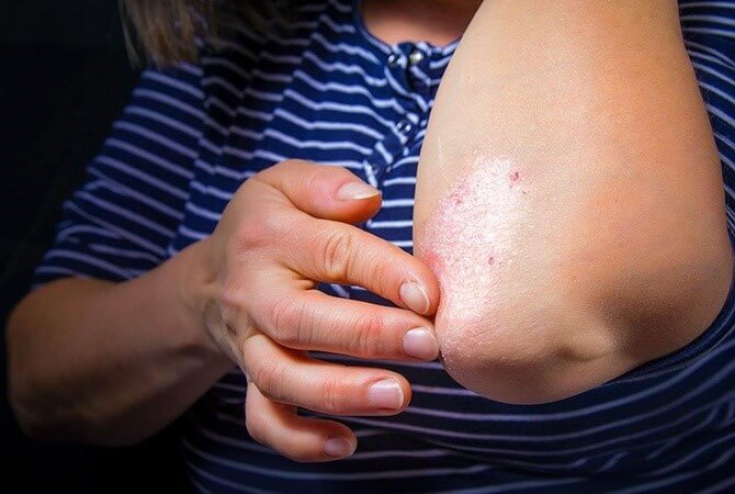 Обновленные рекомендации по лечению псориаза средней и тяжелой степени тяжести