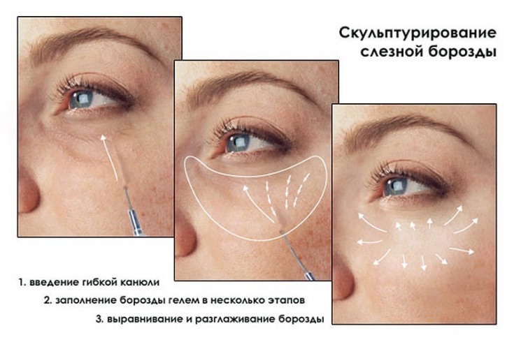Оценка изменений, техника коррекции и возможные осложнения работы с  носослезной бороздой