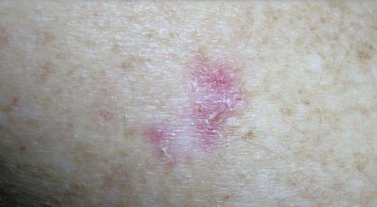 Опасная патология: как проявляются немеланомные поражения кожи