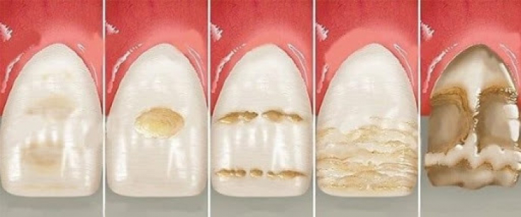 Опасность избыточного содержания фтора в организме: флюороз зубов