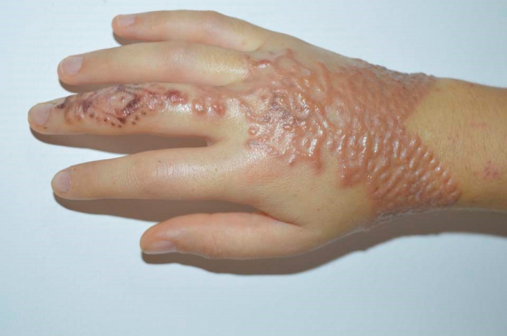 Осложнения тату хной: рекомендации дерматологу