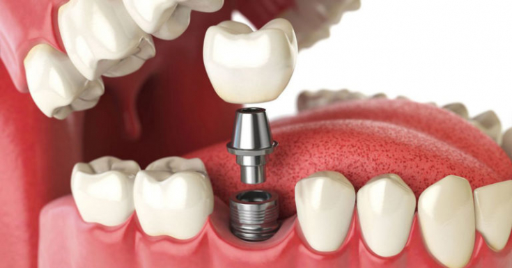 Особенности применения разных видов имплантатов зубов