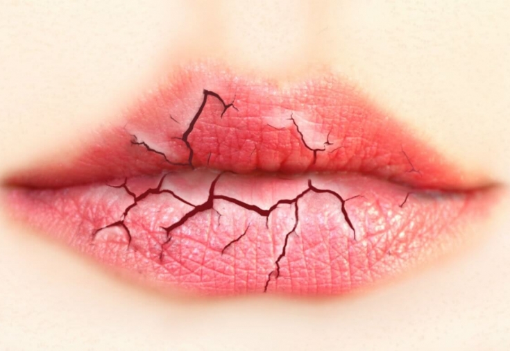 От чего страдают губы: метеорологический хейлит