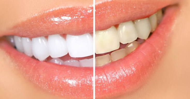 Отбеливание зубов в стоматологии: разновидности методов и их особенности