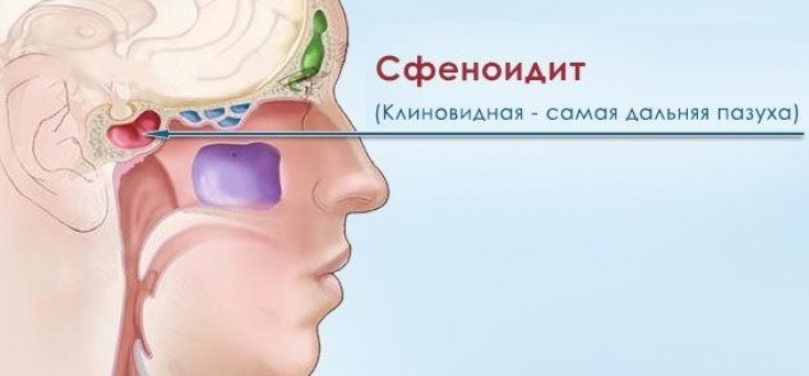Периодическая головная боль - симптом опасного заболевания «сфеноидит» Периодическая головная боль - симптом опасного заболевания «сфеноидит»