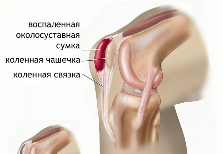 Почему болят колени: причины и следствия