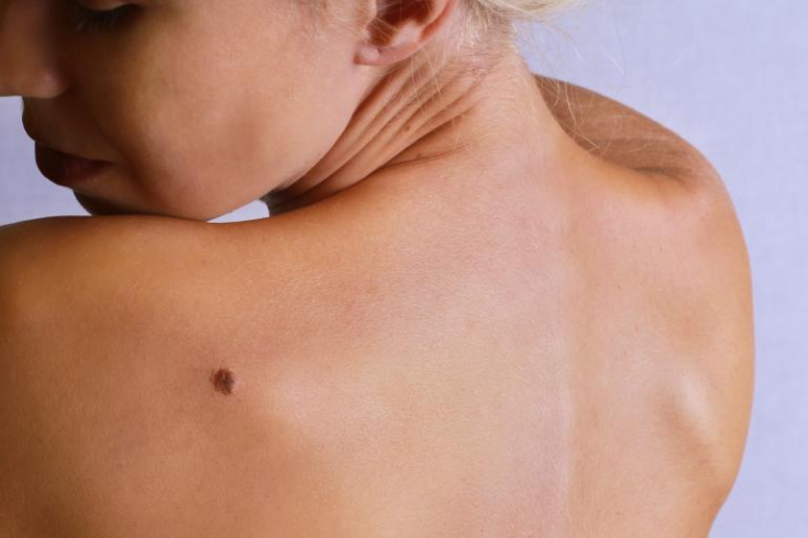 Предрасположенность к меланоме: причины перерождения невусов