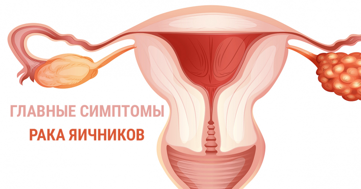 Признаки рака яичников: на что обратить внимание