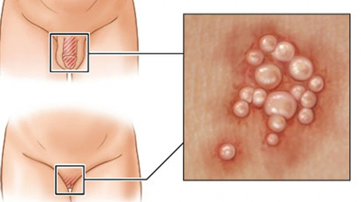 Проявления папилломавирусной инфекции: разновидности аногенитальных бородавок