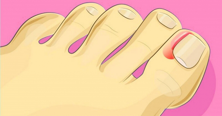 Радиочастотная абляция для матриксэктомии в лечении вросшего ногтя