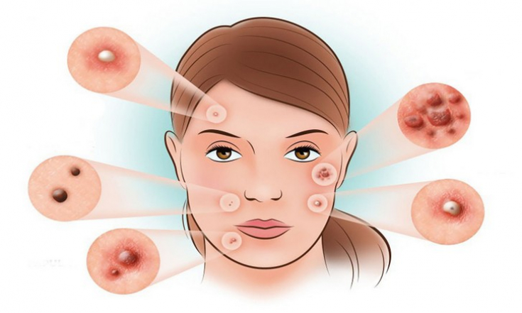 Решающие факторы развития угревой болезни: кожное сало и штамм P. acnes