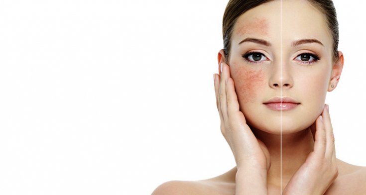 Розацеа: патофизиологические механизмы развития основных симптомов заболевания