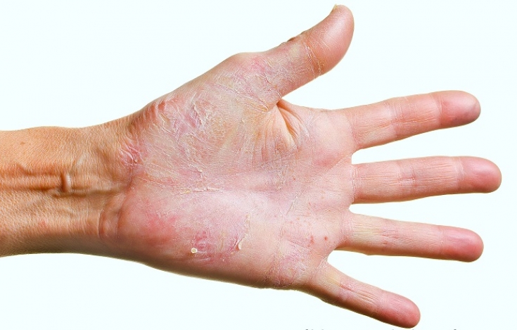 Руки не лгут: особенности клинической картины заболеваний кожи рук