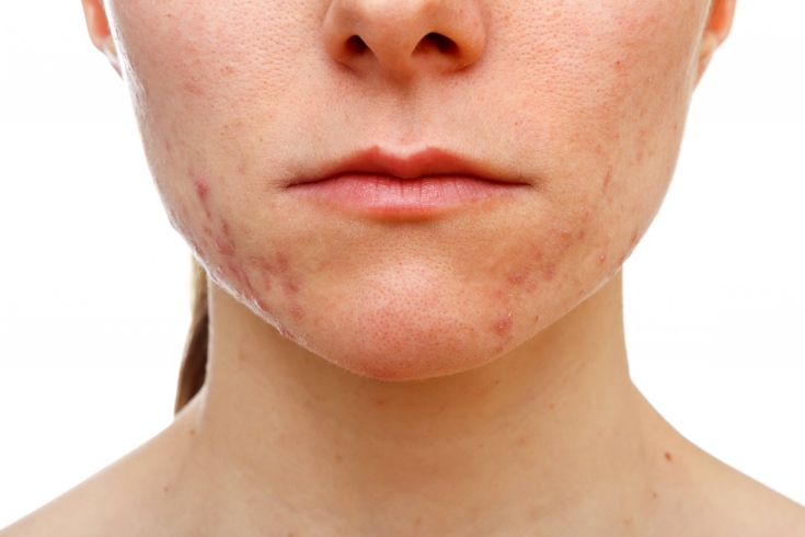 Себорейный дерматит на лице: как избавиться от косметического дефекта