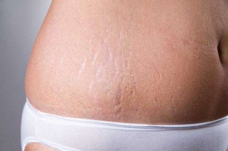 Стрии на коже: почему возникают и как убрать растяжки на теле