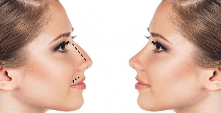 Техника коррекции носа филлерами ГК: инъекционная ринопластика