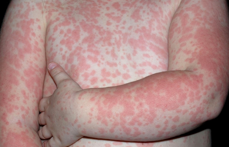 Токсикодермия: причины, симптомы, диагностика, лечение, профилактика