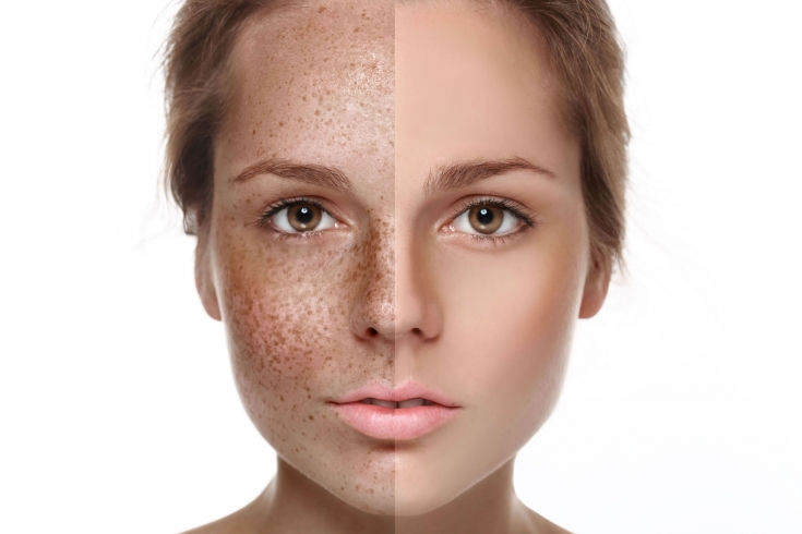 Тусклый цвет кожи лица: в чем причины дефекта