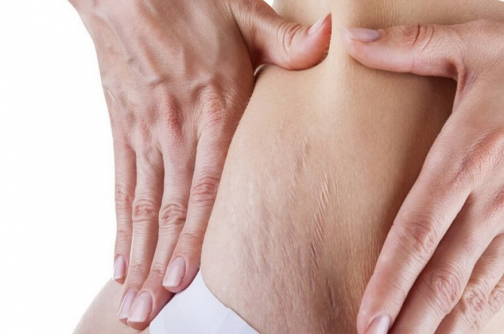 Удаление растяжек на коже при помощи лазера