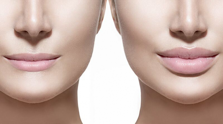 Важные аспекты аугментации губ для получения гармоничного результата