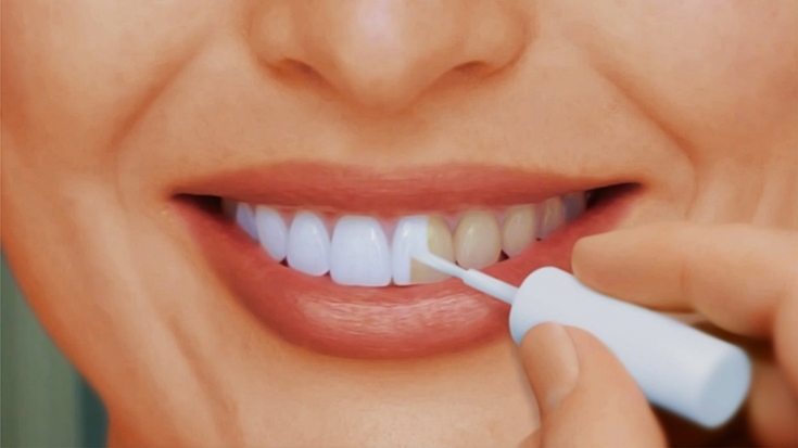 Виды отбеливания зубов: стоит ли пользоваться отбеливающими лаками