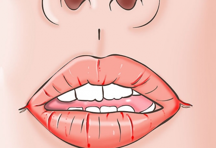 Виды воспаления на губах и их лечение