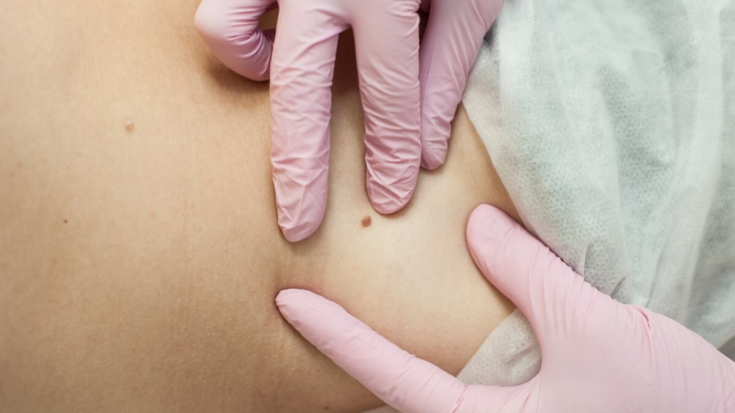 Вирус папилломы человека: нужна ли вакцинация