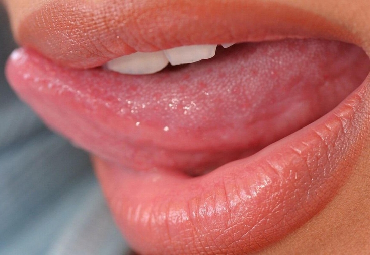 Воспаление нёба: симптомы, причины и лечение