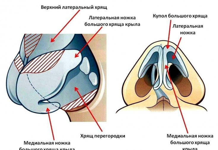 Восстановление формы носа возможно с помощью искусственного хряща